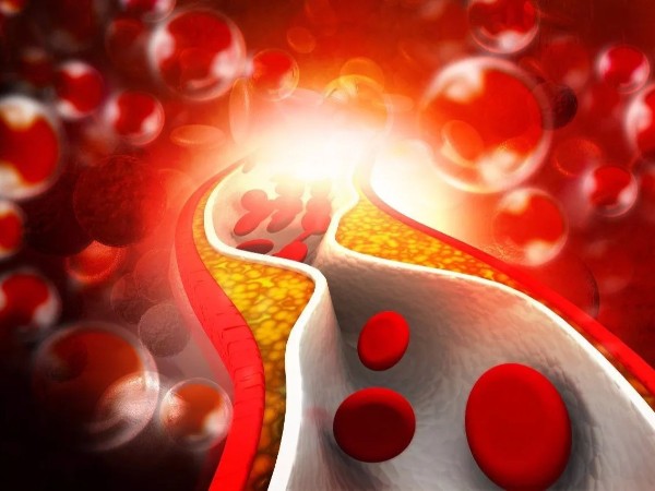 冬天心腦血管頻發(fā)，一定要避免血管堵塞