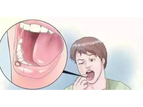 口腔潰瘍反反復復，補充維C就能好？